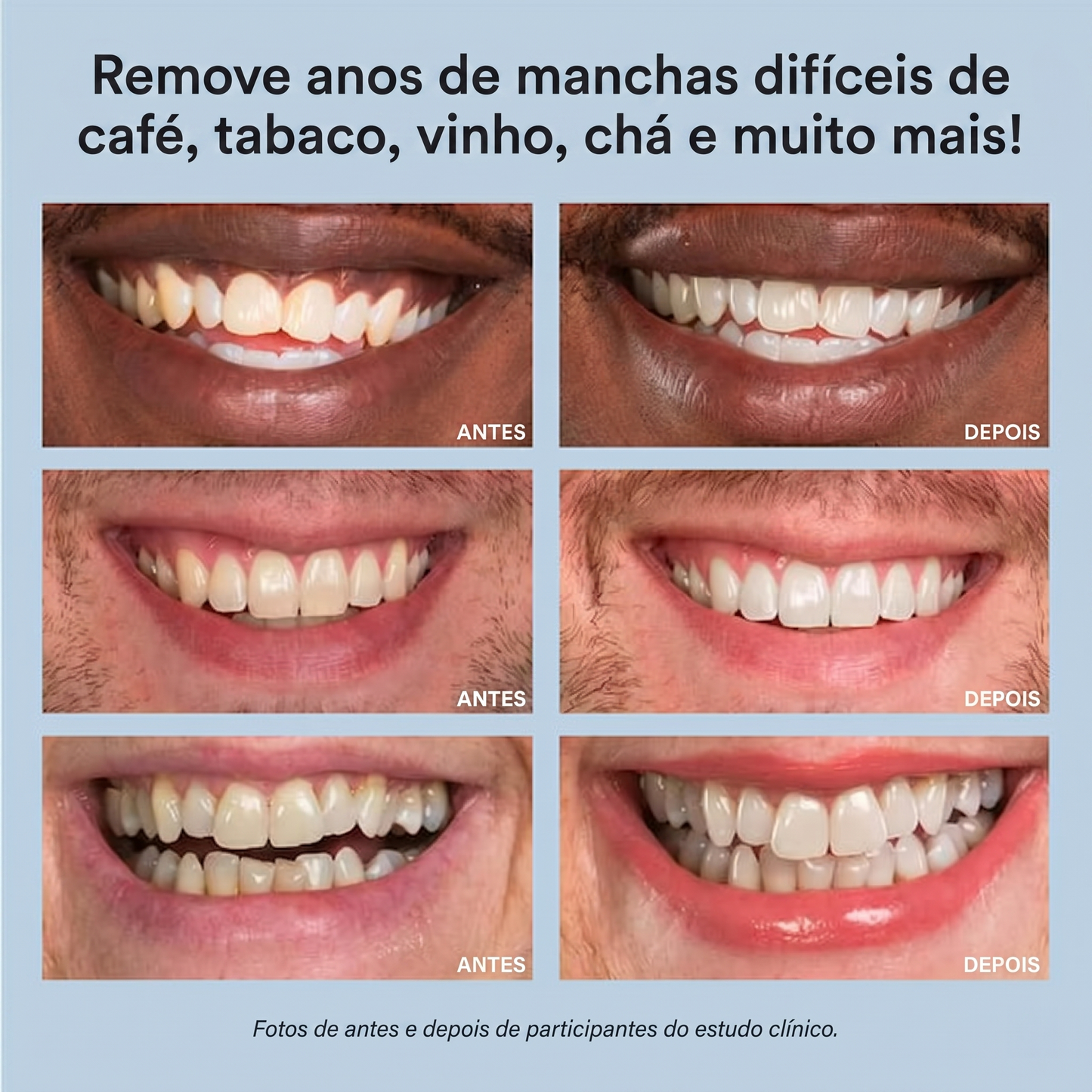 Kit Profissional de Clareador Dental - GlorySmile™